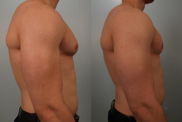 Male Breast/Areola Reduction 10