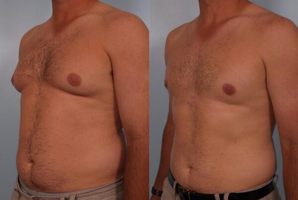 Male Breast/Areola Reduction 11