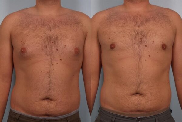 Male Breast/Areola Reduction 12