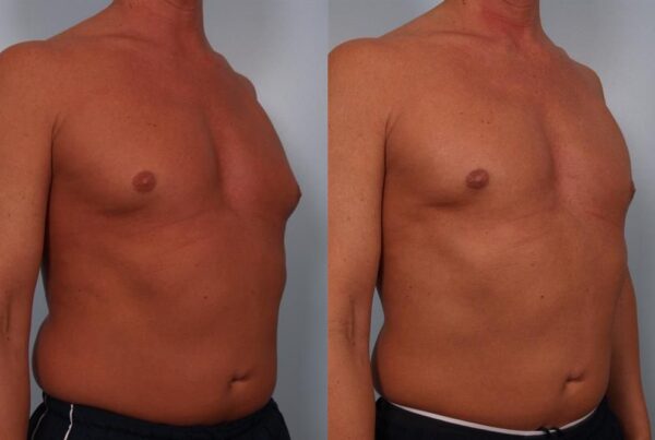 Male Breast/Areola Reduction 13