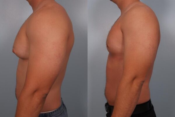 Male Breast/Areola Reduction 14