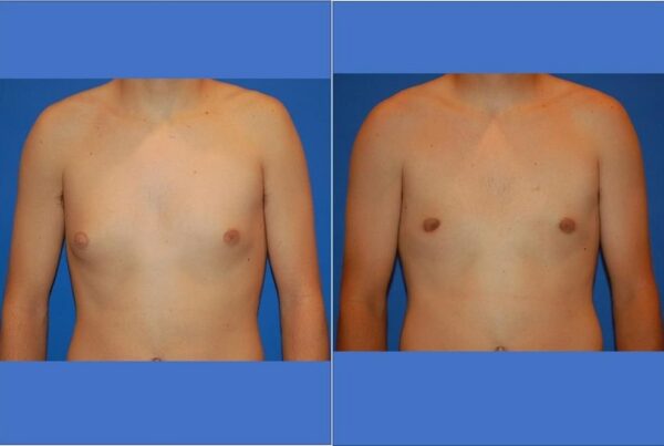 Male Breast/Areola Reduction 15