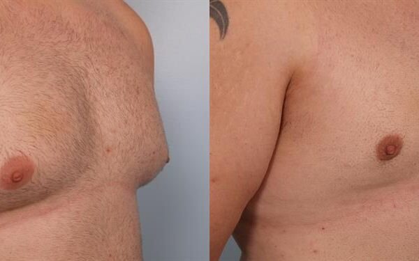 Male Breast/Areola Reduction 16