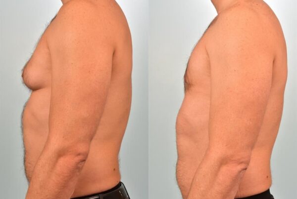 Male Breast/Areola Reduction 17