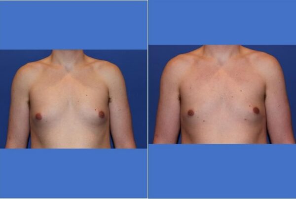 Male Breast/Areola Reduction 18