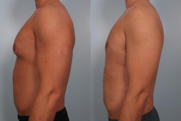 Male Breast/Areola Reduction 19