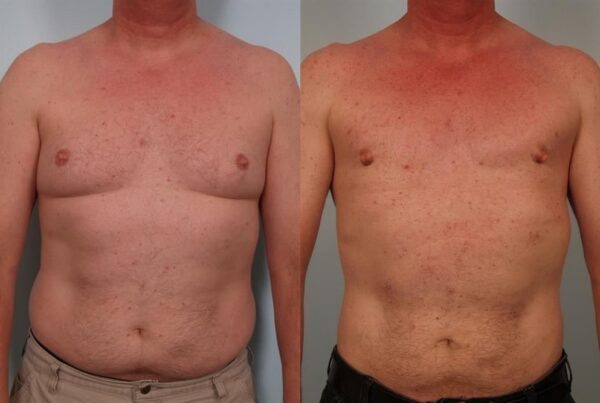 Male Breast/Areola Reduction 2