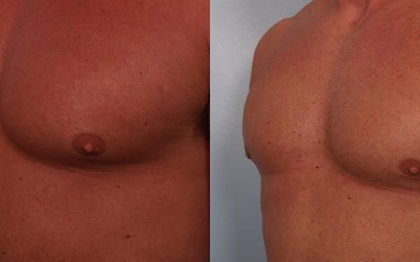 Male Breast/Areola Reduction 20
