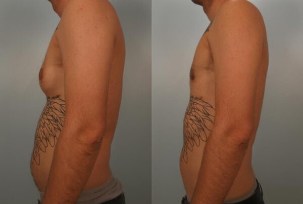 Male Breast/Areola Reduction 21