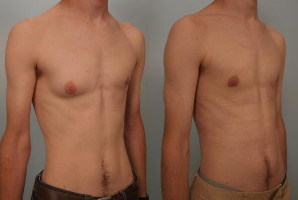 Male Breast/Areola Reduction 3