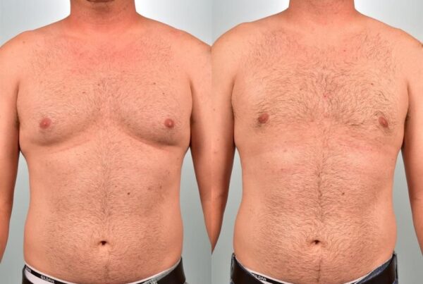 Male Breast/Areola Reduction 4