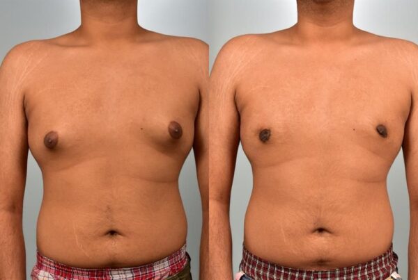 Male Breast/Areola Reduction 5