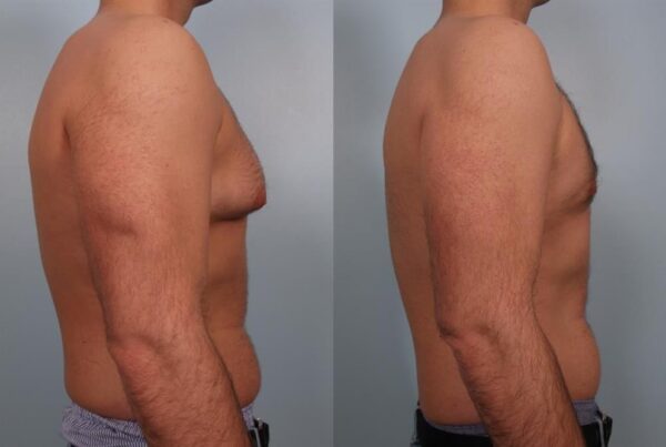 Male Breast/Areola Reduction 6