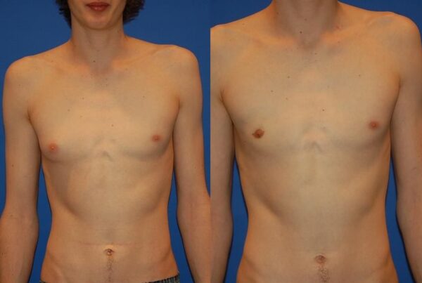 Male Breast/Areola Reduction 7