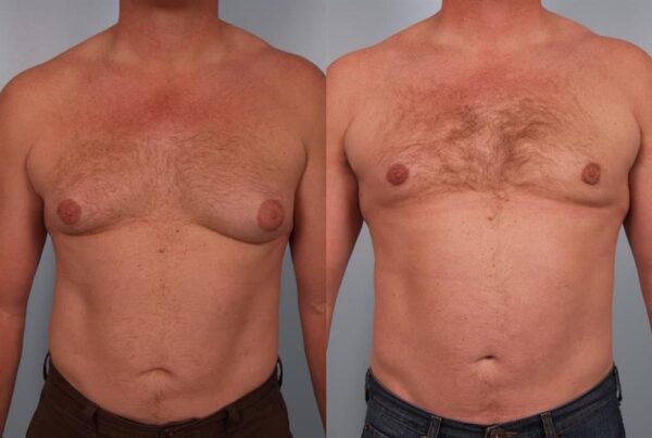Male Breast/Areola Reduction 8
