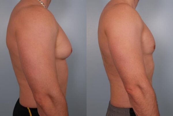 Male Breast/Areola Reduction 9