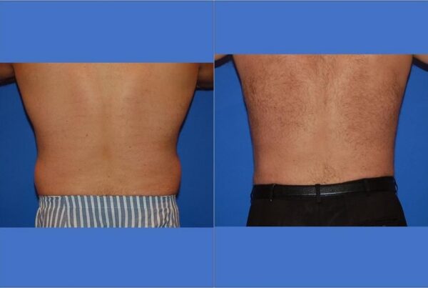 Male Liposuction 1