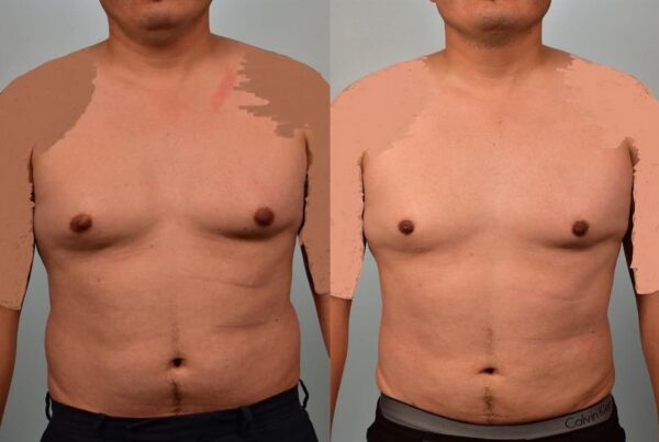 Male Liposuction 2