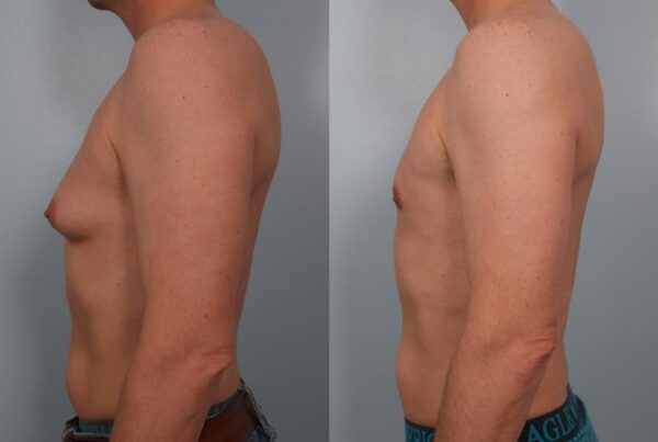 Male Liposuction 3
