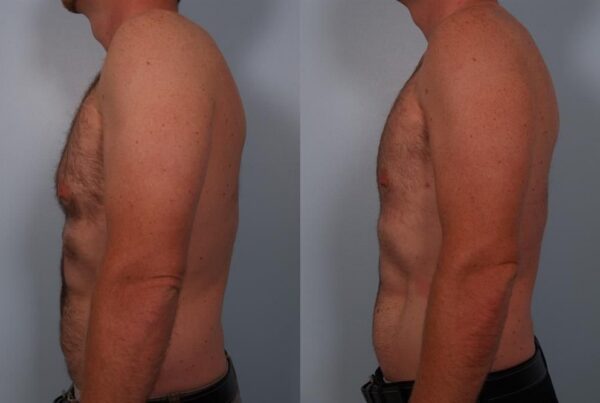 Male Liposuction 4