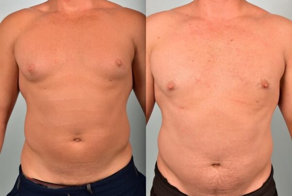 Male Liposuction 5