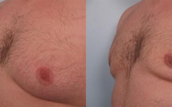 Male Liposuction 6