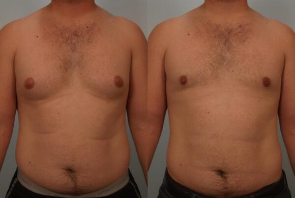 Male Liposuction 7