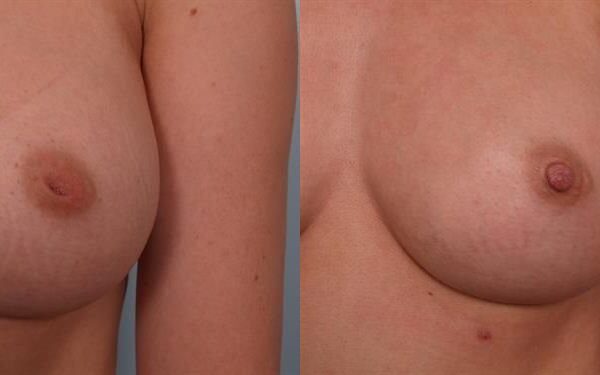 Nipple/Areolar Surgery 1
