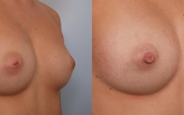 Nipple/Areolar Surgery 2