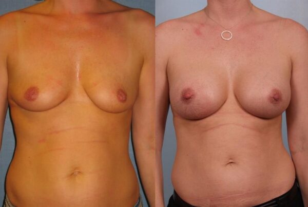 Nipple/Areolar Surgery 3