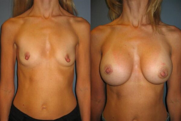 Nipple/Areolar Surgery 4