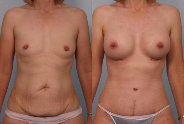 Nipple/Areolar Surgery 5