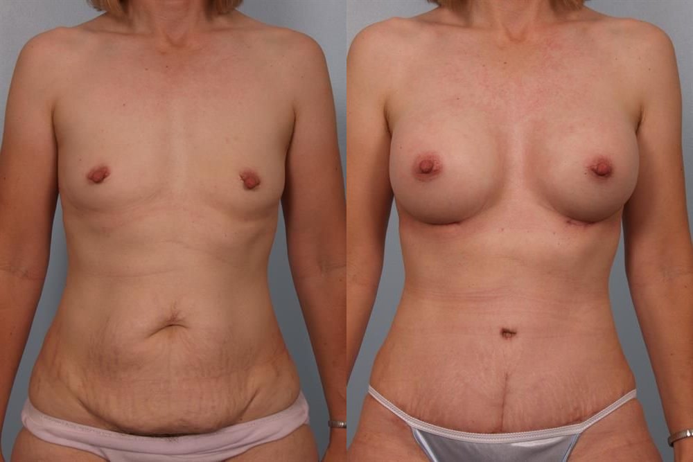 Nipple/Areolar Surgery 5