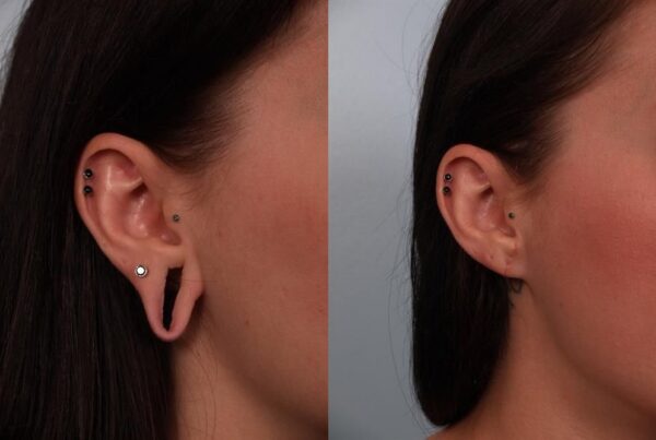Otoplasty (Ear Reshaping) 1