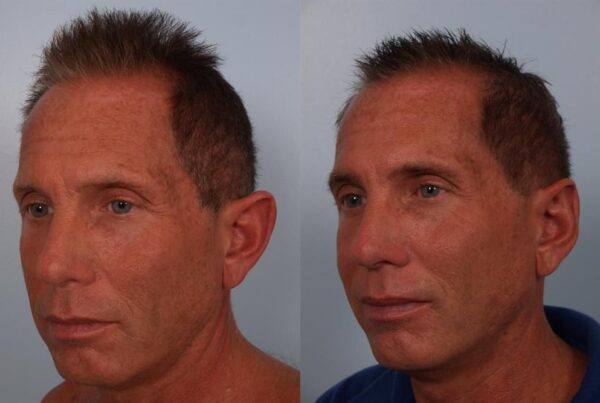 Otoplasty (Ear Reshaping) 2