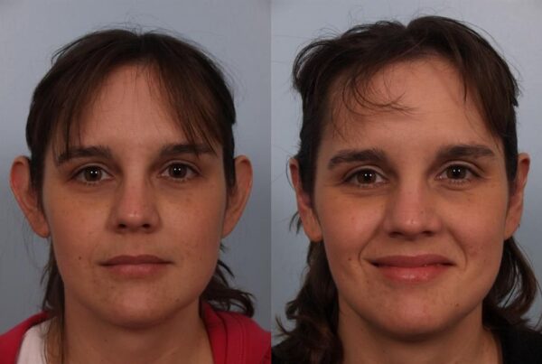 Otoplasty (Ear Reshaping) 3
