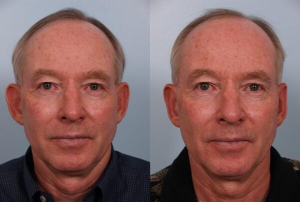Otoplasty (Ear Reshaping) 4