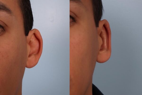Otoplasty (Ear Reshaping) 5
