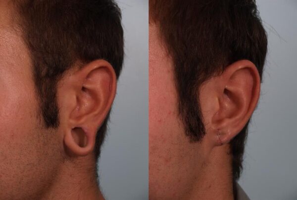 Otoplasty (Ear Reshaping) 6