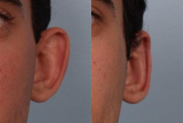 Otoplasty (Ear Reshaping) 7