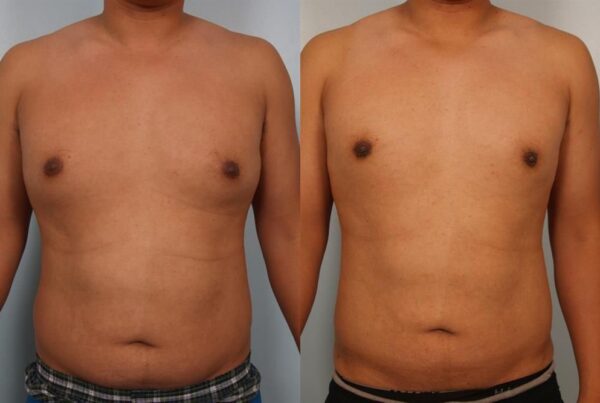 Power Assisted Liposuction 1