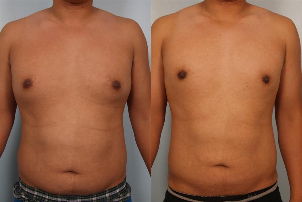 Power Assisted Liposuction 1