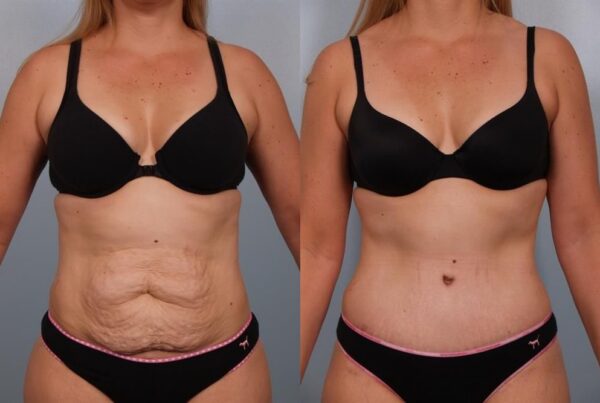 Power Assisted Liposuction 10