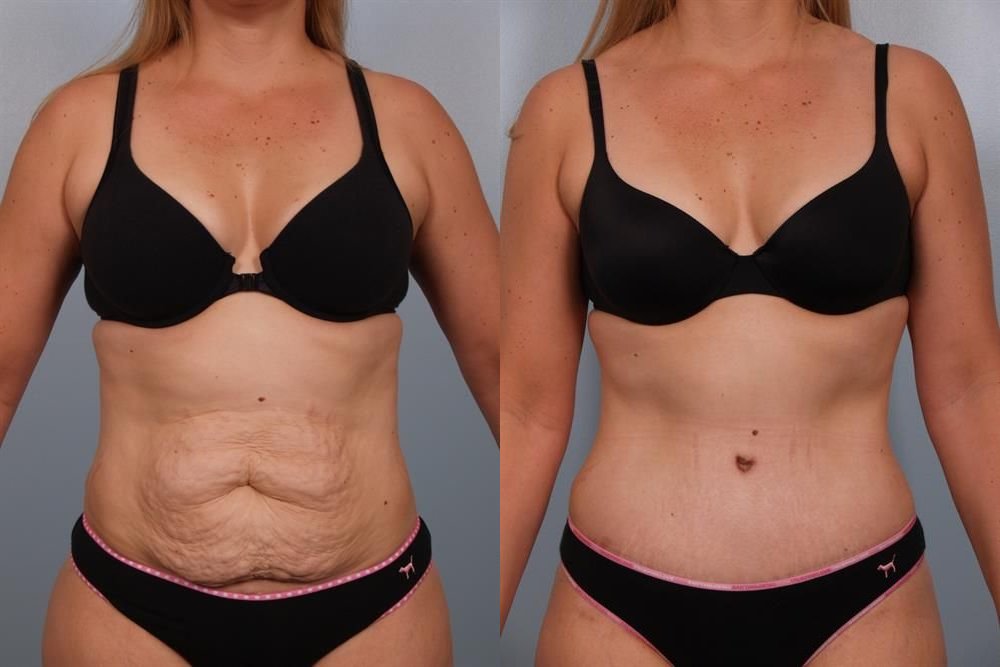 Power Assisted Liposuction 10