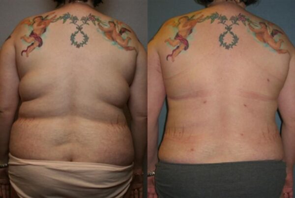 Power Assisted Liposuction 11