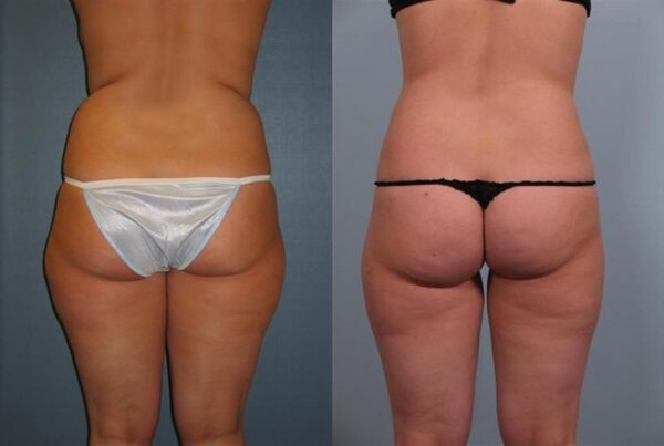 Power Assisted Liposuction 12
