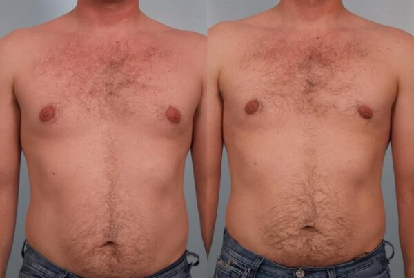 Power Assisted Liposuction 13