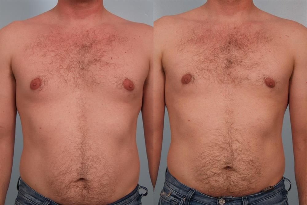 Power Assisted Liposuction 13