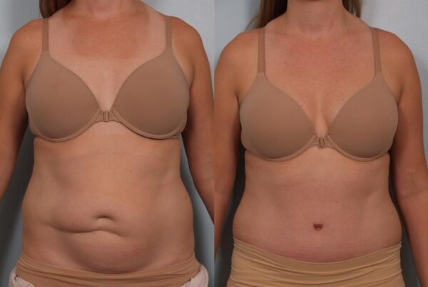 Power Assisted Liposuction 14