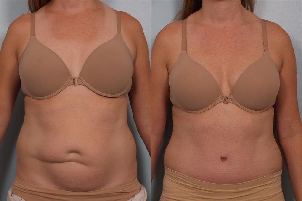 Power Assisted Liposuction 14